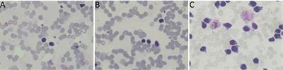 Case report: A rare case of coexisting Waldenstrom Macroglobulinemia and B-cell acute lymphoblastic leukemia with KMT2D and MECOM mutations